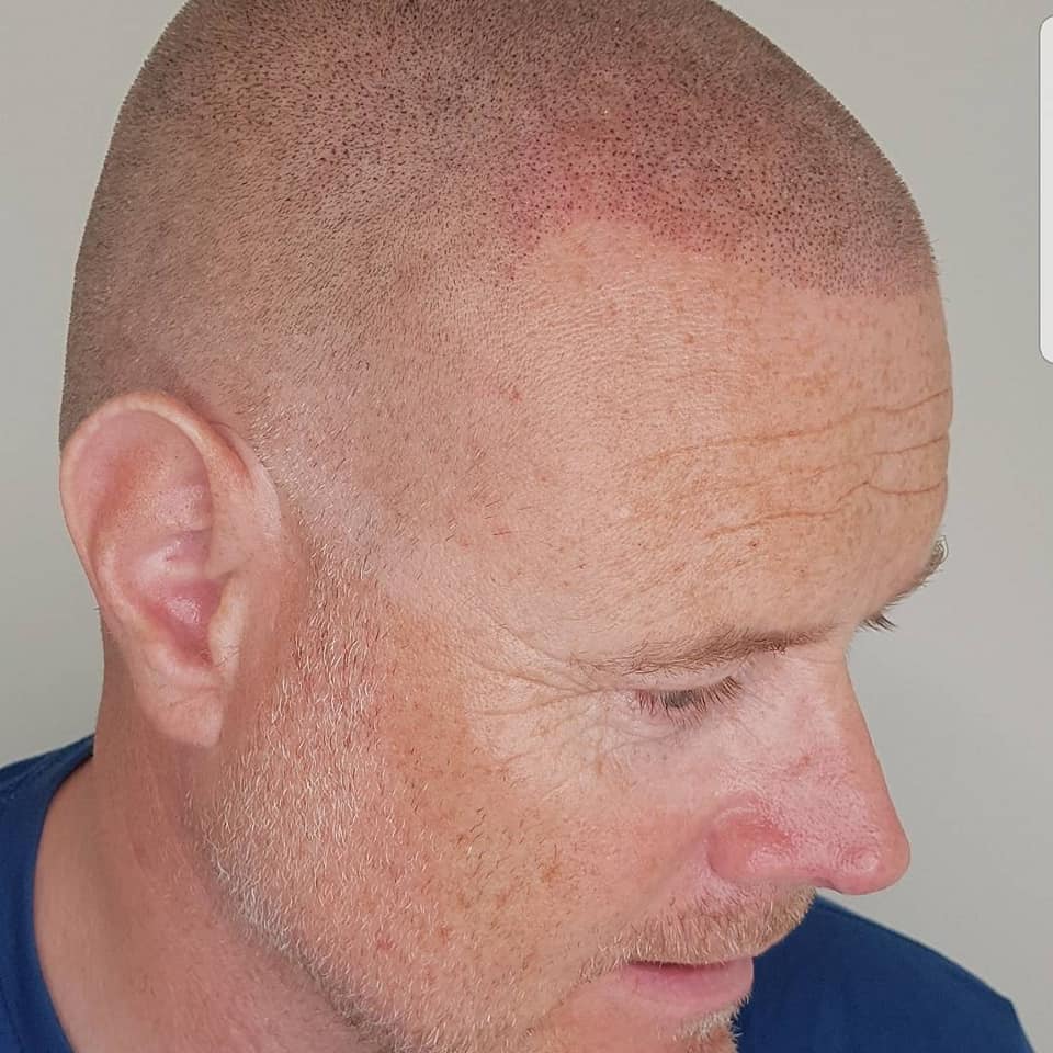Hva er Scalp micro pigmentering