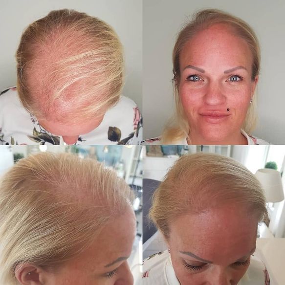 Alopecia - hårtap kvinner