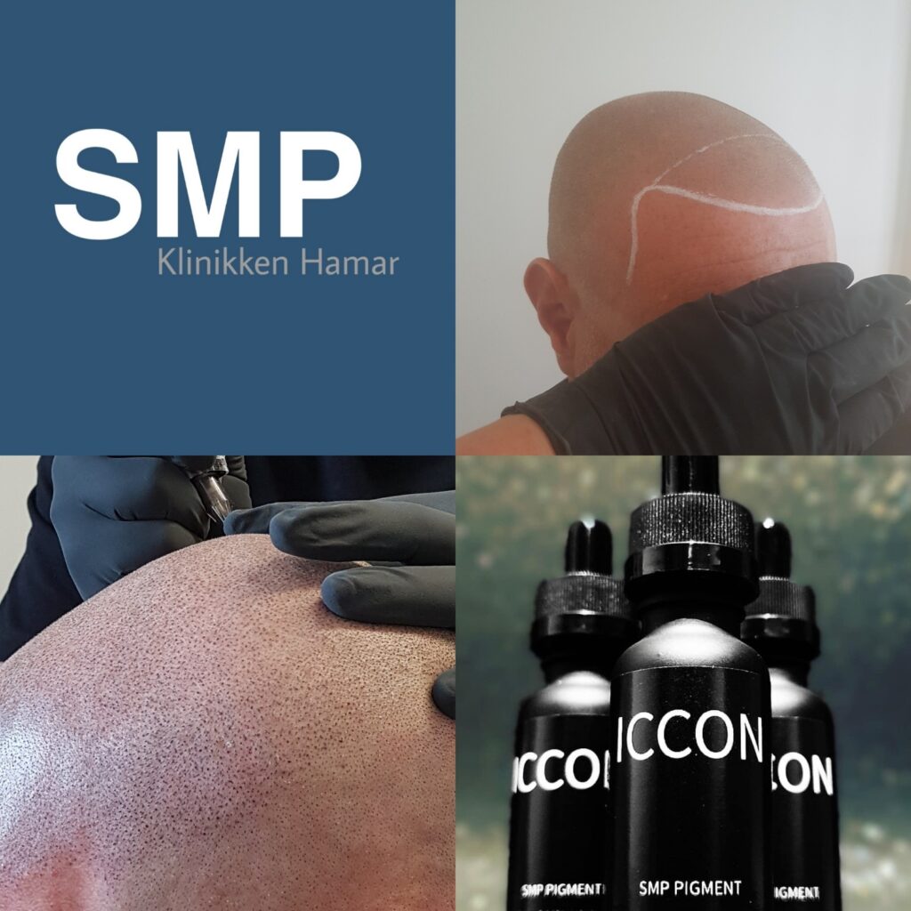 SMP vs hårtransplantasjon